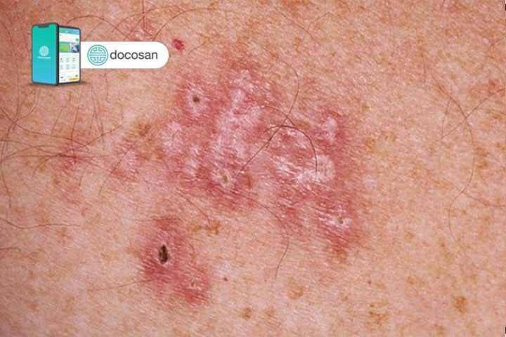 Điều Trị Nấm Da Bìu: Các Loại Thuốc Hiệu Quả và Lưu Ý