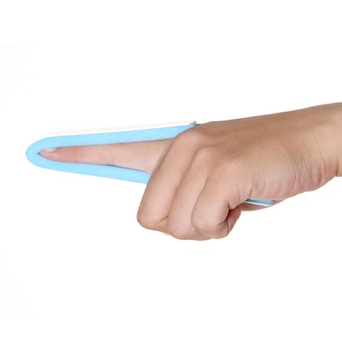 Nẹp Iselin: Giải pháp cố định hiệu quả trong y học
