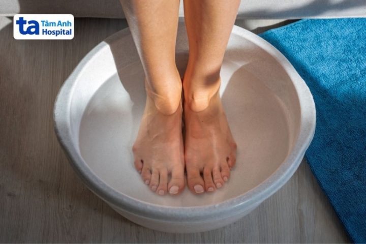 Cách Trị Giãn Tĩnh Mạch Chân Tại Nhà Hiệu Quả và An Toàn