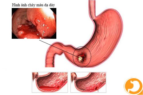 Thuốc Điều Trị Viêm Xung Huyết Hang Vị Dạ Dày Hiệu Quả Và An Toàn