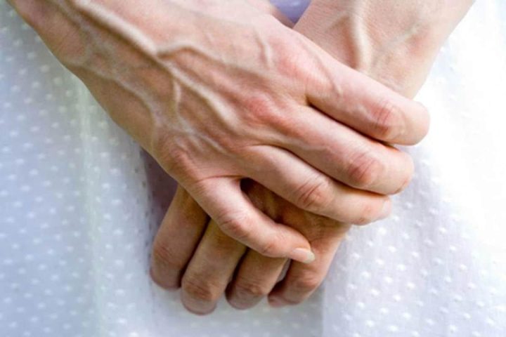 Hình ảnh mô tả các tĩnh mạch nổi rõ dưới da, biểu hiện của nổi gân xanh