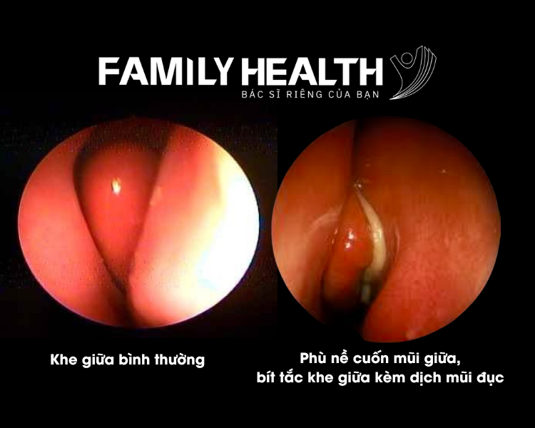 Viêm Mũi Cấp: Nguyên Nhân, Triệu Chứng, Cách Điều Trị Hiệu Quả Viêm Mũi Cấp: Nguyên Nhân, Triệu Chứng, Cách Điều Trị Hiệu Quả