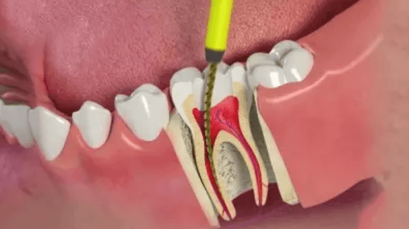 Phác đồ điều trị tủy răng chi tiết với các bước cơ bản