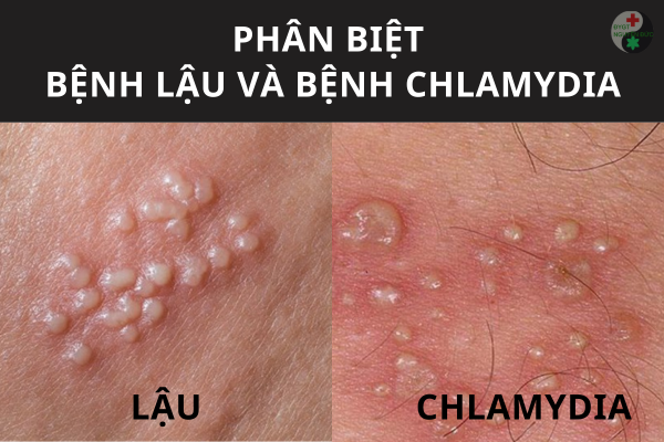 Những Thuốc Gì Khi Cùng Lúc Nhiễm Chlamydia Với Lậu Hiệu Quả Nhất
