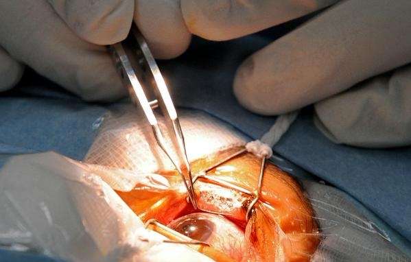 Sau Phẫu Thuật Đục Thủy Tinh Thể Dùng Thuốc Gì: Hướng Dẫn Chi Tiết