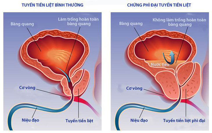 Bị Phì Đại Tiền Liệt Tuyến Nên Uống Thuốc Gì Để Điều Trị Hiệu Quả