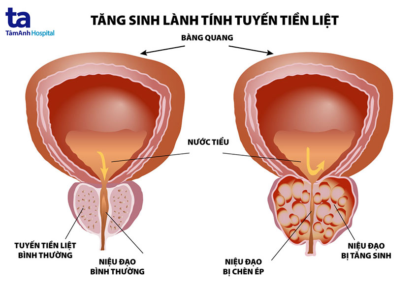 Bị Phì Đại Tiền Liệt Tuyến Nên Uống Thuốc Gì Để Điều Trị Hiệu Quả