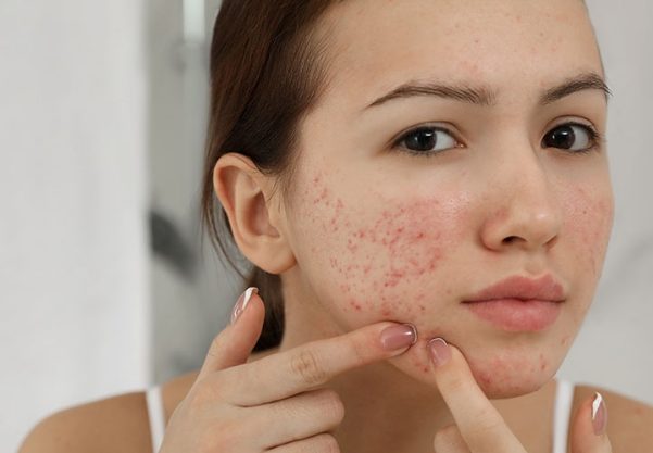 Khắc Phục Da Dùng Thuốc Gì Cũng Không Hết Mụn Dai Dẳng