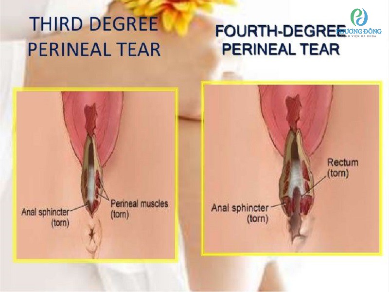 Thuốc Xử Lý Nhiễm Trùng Vết May Tầng Sinh Môn Hiệu Quả và An Toàn