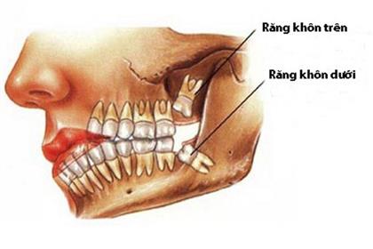 Mọc Răng Số 8 Hàm Dưới: Nguyên Nhân, Biến Chứng và Giải Pháp Điều Trị