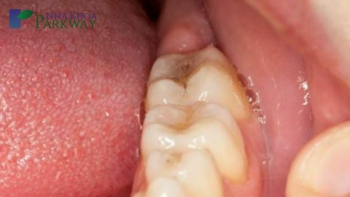 Mọc Răng Số 8 Hàm Dưới: Nguyên Nhân, Biến Chứng và Giải Pháp Điều Trị
