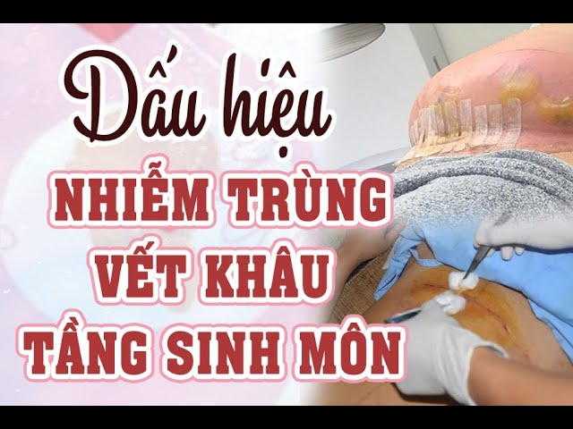 Thuốc Xử Lý Nhiễm Trùng Vết May Tầng Sinh Môn Hiệu Quả và An Toàn