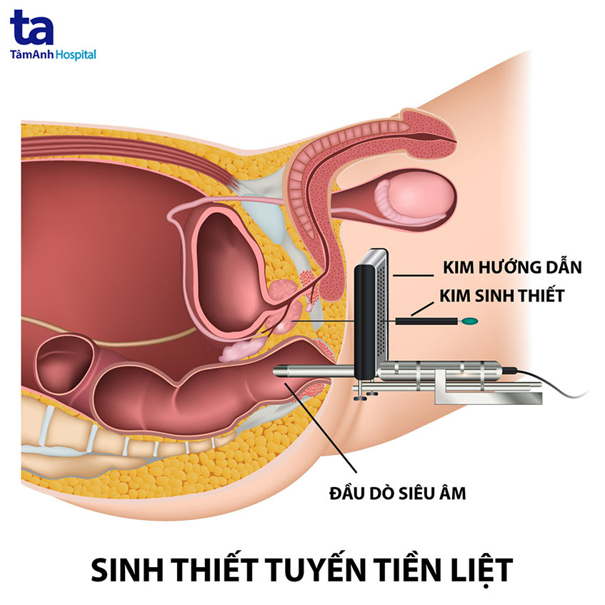 Các Loại Thuốc Điều Trị Phì Đại Tuyến Tiền Liệt Hiệu Quả Hiện Nay