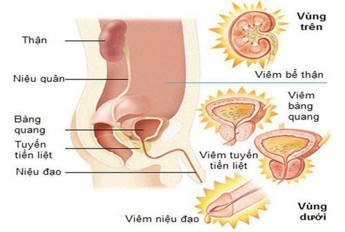 Thuốc điều trị viêm đường tiết niệu ở nam giới hiệu quả