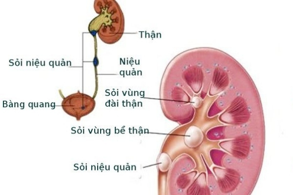 Sỏi Niệu Quản Uống Thuốc Nam: Phân Tích Khoa Học & Giải Pháp Toàn Diện