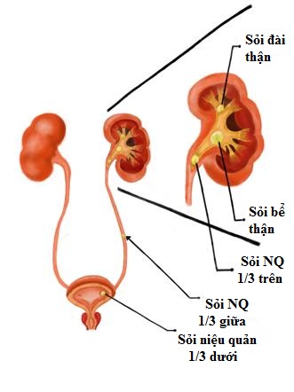 Sỏi Niệu Quản Uống Thuốc Nam: Phân Tích Khoa Học & Giải Pháp Toàn Diện