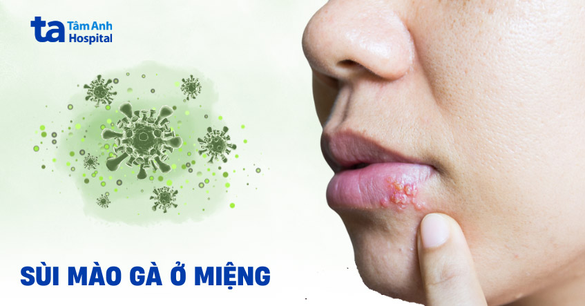 Uống Thuốc Gì Để Không Tái Phát Sùi Mào Gà: Giải Pháp Toàn Diện