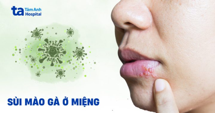 Điều trị sùi mào gà bằng thuốc Podophyllin hiệu quả: Hướng dẫn chi tiết