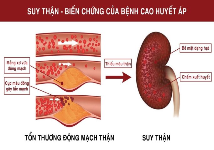 Thiết bị đo huyết áp và thận bị ảnh hưởng bởi bệnh suy thận