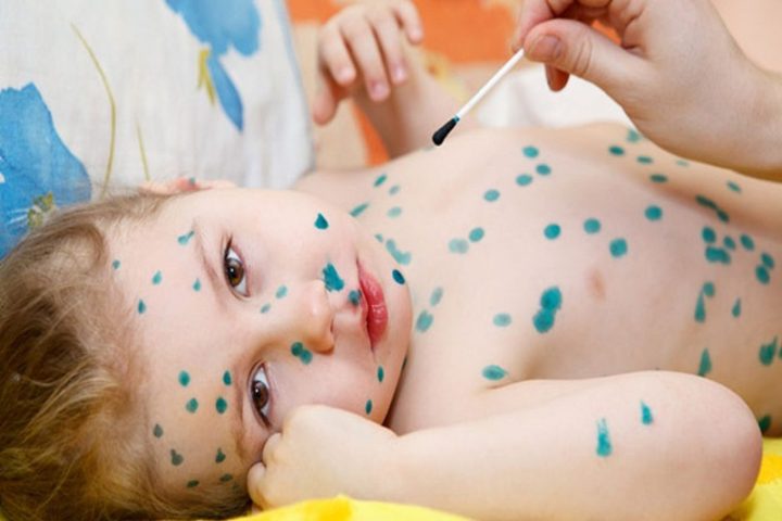 Hướng dẫn dùng thuốc bôi miệng methylen cho trẻ chân tay miệng Hướng dẫn dùng thuốc bôi miệng methylen cho trẻ chân tay miệng