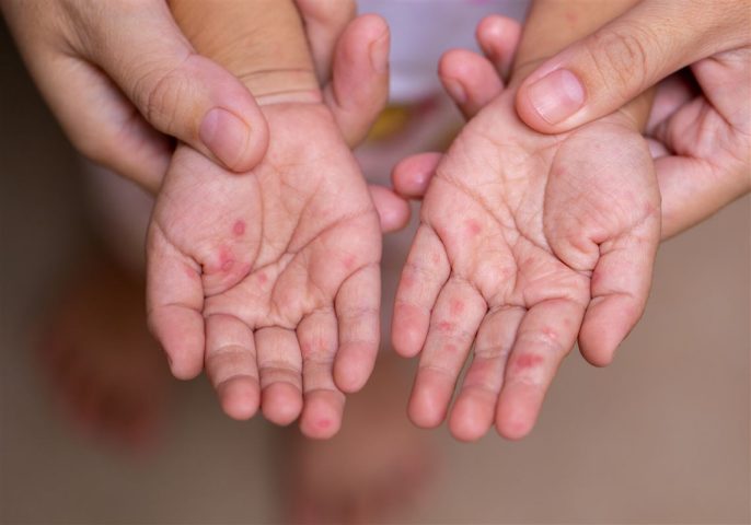 Hướng dẫn dùng thuốc bôi miệng methylen cho trẻ chân tay miệng Hướng dẫn dùng thuốc bôi miệng methylen cho trẻ chân tay miệng