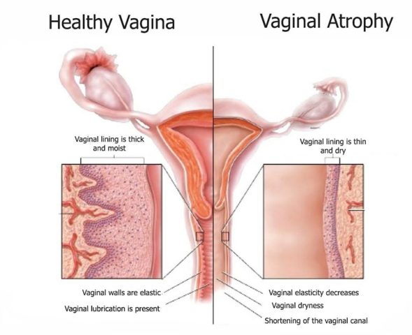 Điều Trị Teo Âm Đạo Bằng Thuốc Nội Tiết: Hướng Dẫn Chi Tiết