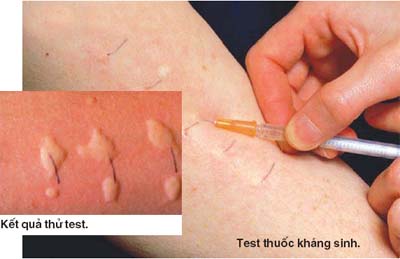 Uống Kháng Sinh Trong Quá Trình Dùng Thuốc Dị Ứng: Hướng Dẫn Chi Tiết