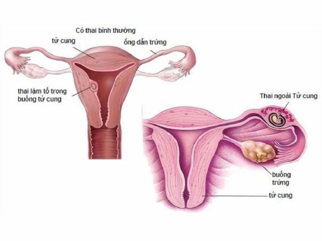 Thai Chưa Vào Tử Cung: Nguyên Nhân, Dấu Hiệu Và Cách Xử Lý Hiệu Quả Thai Chưa Vào Tử Cung: Nguyên Nhân, Dấu Hiệu Và Cách Xử Lý Hiệu Quả