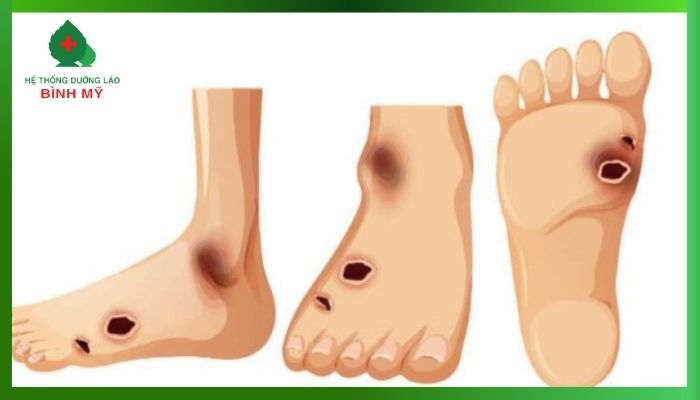 Người già ngồi tựa đầu gối, biểu hiện của sự khó chịu hoặc mệt mỏi do phù chân