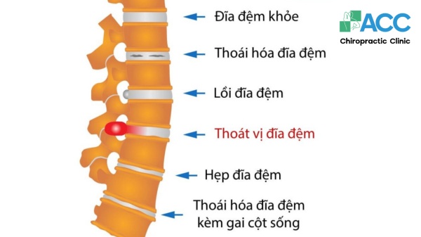 Nhà Thuốc Kầm Thiên Chuyên Trị Thoát Vị Đĩa Đệm: Đánh Giá Chi Tiết Nhà Thuốc Kầm Thiên Chuyên Trị Thoát Vị Đĩa Đệm: Đánh Giá Chi Tiết