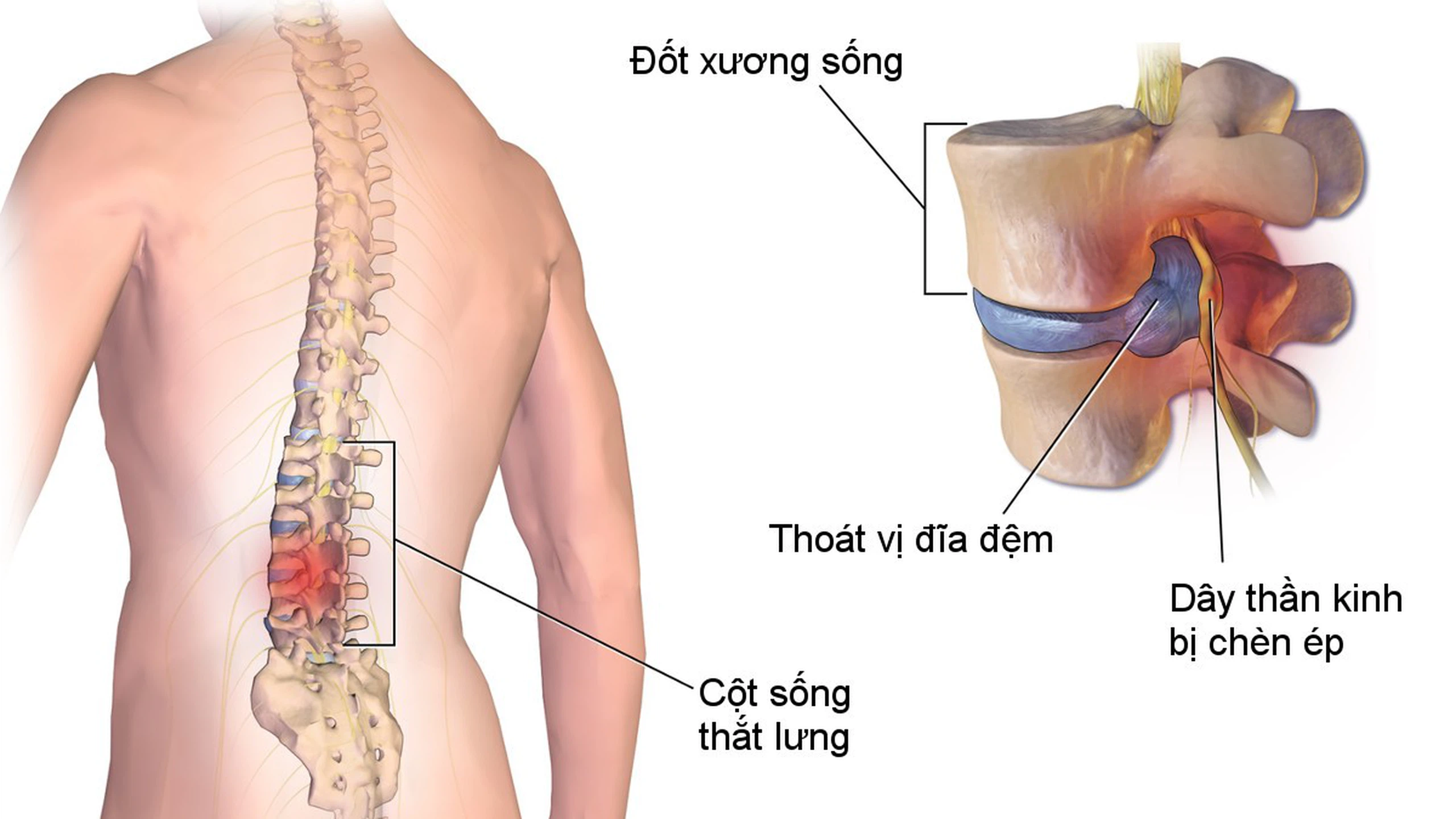 Nhà Thuốc Kầm Thiên Chuyên Trị Thoát Vị Đĩa Đệm: Đánh Giá Chi Tiết