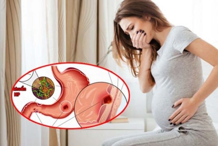 Ảnh Hưởng Của Thuốc Dạ Dày Đến Thai Nhi: Hướng Dẫn Chi Tiết