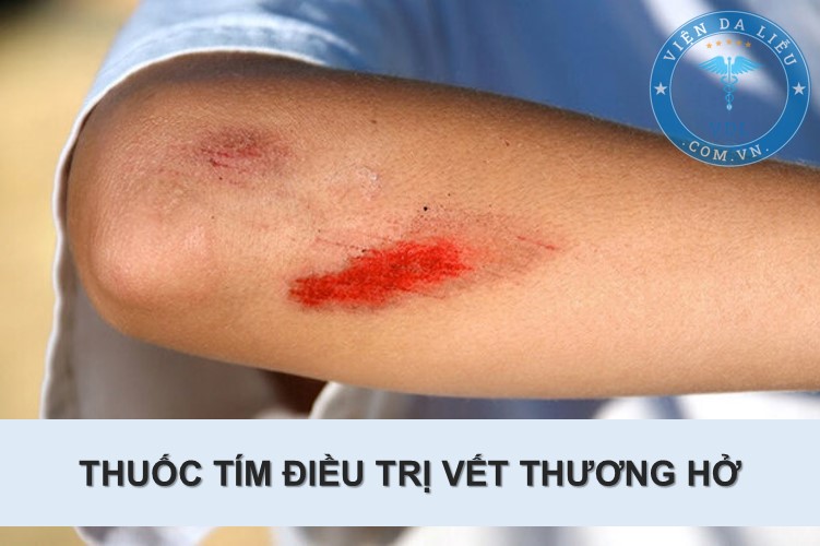 Được Bôi Thuốc Tím Lên Vết Mổ Sinh Sản Không: Chuyên Gia Giải Đáp