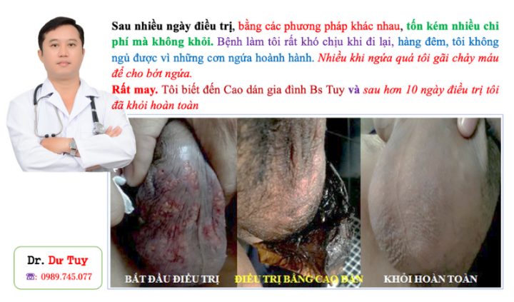 Điều Trị Nấm Da Bìu: Các Loại Thuốc Hiệu Quả và Lưu Ý