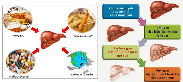 Tế bào gan bị tổn thương