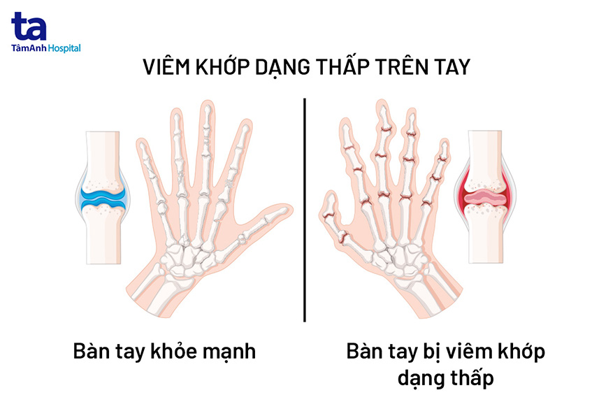 Bài Thuốc Dân Gian Chữa Viêm Đa Khớp Dạng Thấp Hiệu Quả Bài Thuốc Dân Gian Chữa Viêm Đa Khớp Dạng Thấp Hiệu Quả
