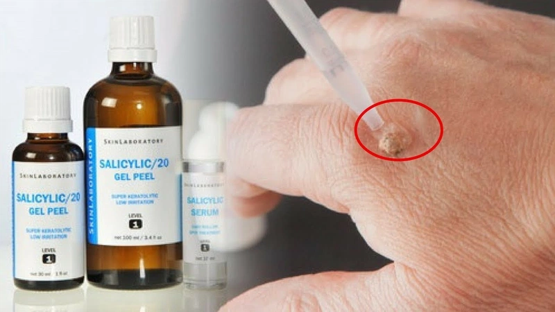 Thuốc Bôi Trị Mụn Cóc Chiết Xuất Từ Tự Nhiên: Giải Pháp An Toàn và Hiệu Quả