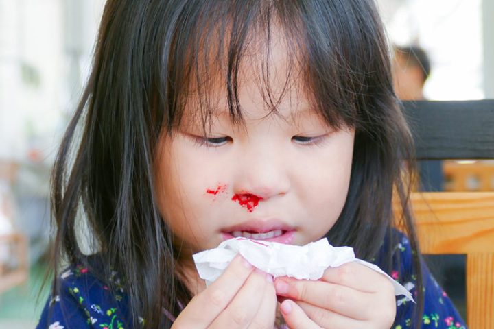 Sốt Chảy Máu Mũi: Hiểu Rõ Nguyên Nhân và Xử Lý Đúng Cách