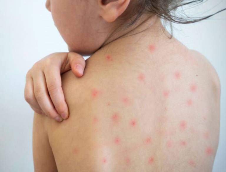 Trẻ Nổi Mẩn Đỏ Sau Khi Uống Thuốc Viêm Amidan: Nguyên Nhân Và Cách Xử Lý Hiệu Quả