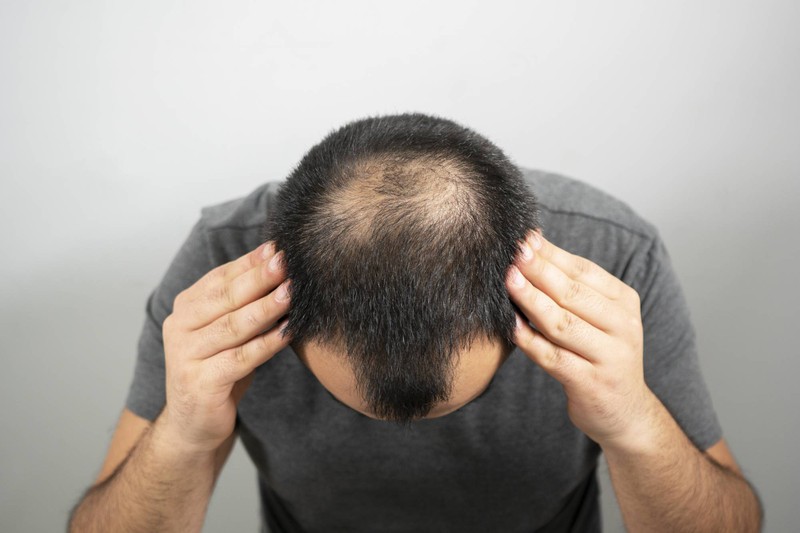 Thuốc Đặc Trị Chống Rụng Tóc Cho Nam Giới Foltène: Giải Pháp Toàn Diện