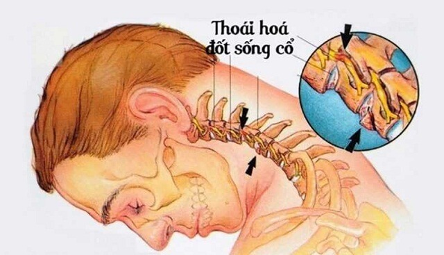 Bị Thoái Hóa Cột Sống Cổ Nên Uống Thuốc Gì: Hướng Dẫn Chi Tiết