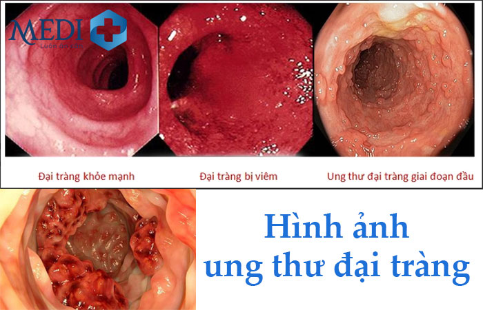 Điều Trị Ung Thư Đại Tràng Sigma: Các Phương Pháp Hiệu Quả Toàn Diện Điều Trị Ung Thư Đại Tràng Sigma: Các Phương Pháp Hiệu Quả Toàn Diện
