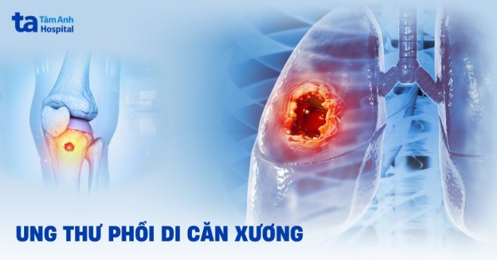 Cách Điều Trị Ung Thư Di Căn Xương Bằng Cây Thuốc Hiệu Quả Cách Điều Trị Ung Thư Di Căn Xương Bằng Cây Thuốc Hiệu Quả