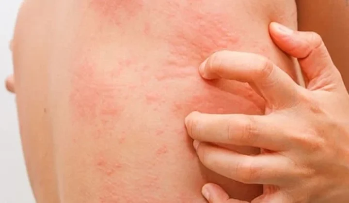 Người bị ngứa da sau khi uống thuốc trị giun sán cần được xử lý kịp thời