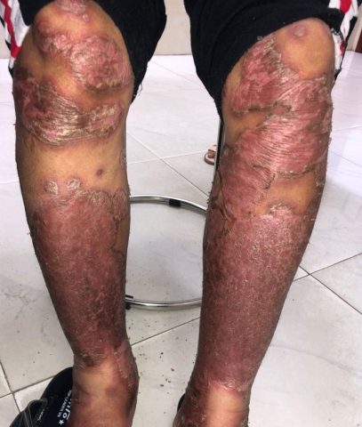 Bệnh Nhân Nằm Lâu Bị Lở Loét Bôi Thuốc Gì Hiệu Quả Nhất