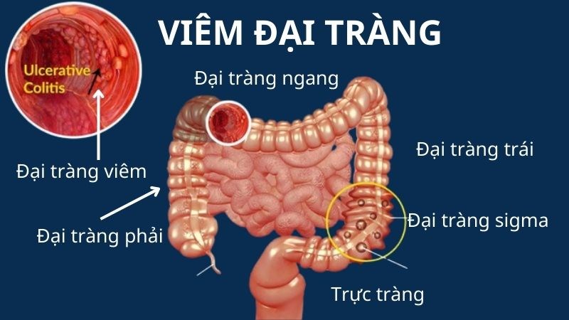Viêm Đại Tràng Uống Thuốc Tẩy Giun: Điều Cần Biết Từ Chuyên Gia