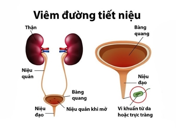 Thuốc Trị Viêm Đường Tiết Niệu Ở Nữ Năm 2017: Tổng Quan Và Hướng Dẫn Điều Trị