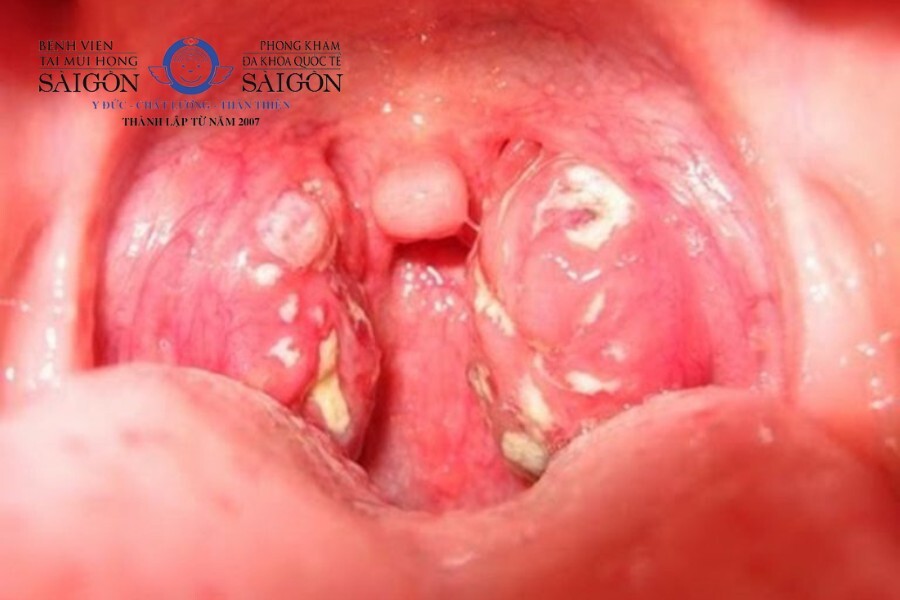 Dùng Thuốc Tây Khó Chữa Dứt Điểm Viêm Họng Hạt: Giải Pháp Toàn Diện