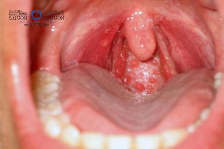 Cổ họng nổi gân máu: Nguyên nhân và cách điều trị hiệu quả Cổ họng nổi gân máu: Nguyên nhân và cách điều trị hiệu quả
