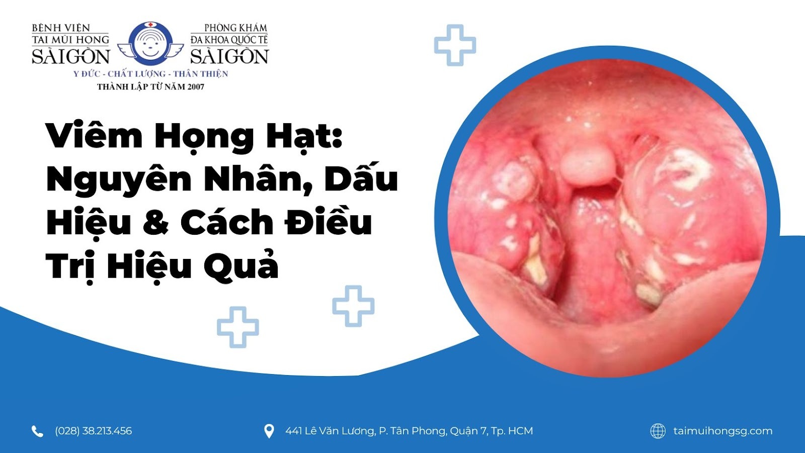 Dùng Thuốc Tây Khó Chữa Dứt Điểm Viêm Họng Hạt: Giải Pháp Toàn Diện